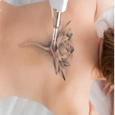 tatoo laser removing پاک کردن تاتو با لیزر