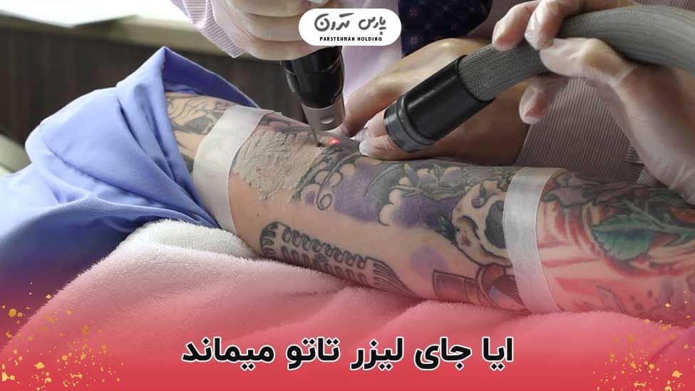 Does laser tattoo removal leave a scar ایا جای لیزر تاتو میماند