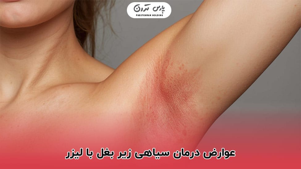 Complications of laser treatment for dark armpits عوارض درمان سیاهی زیر بغل با لیزر