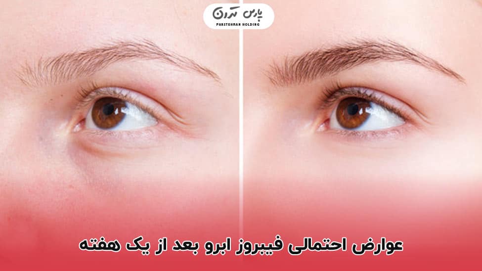 Possible complications of eyebrow fibrosis after one week عکس فیبروز ابرو بعد از یک هفته