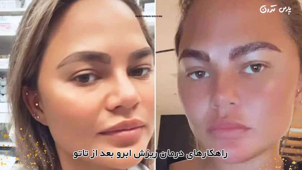 Solutions for treating eyebrow loss after tattooing راهکارهای درمان ریزش ابرو بعد از تاتو