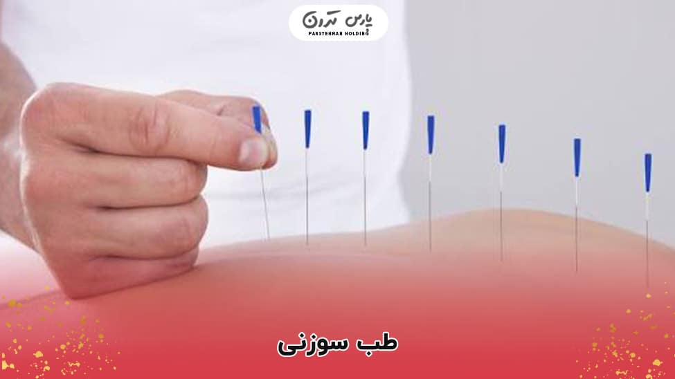 Acupuncture طب سوزنی برای لاغری