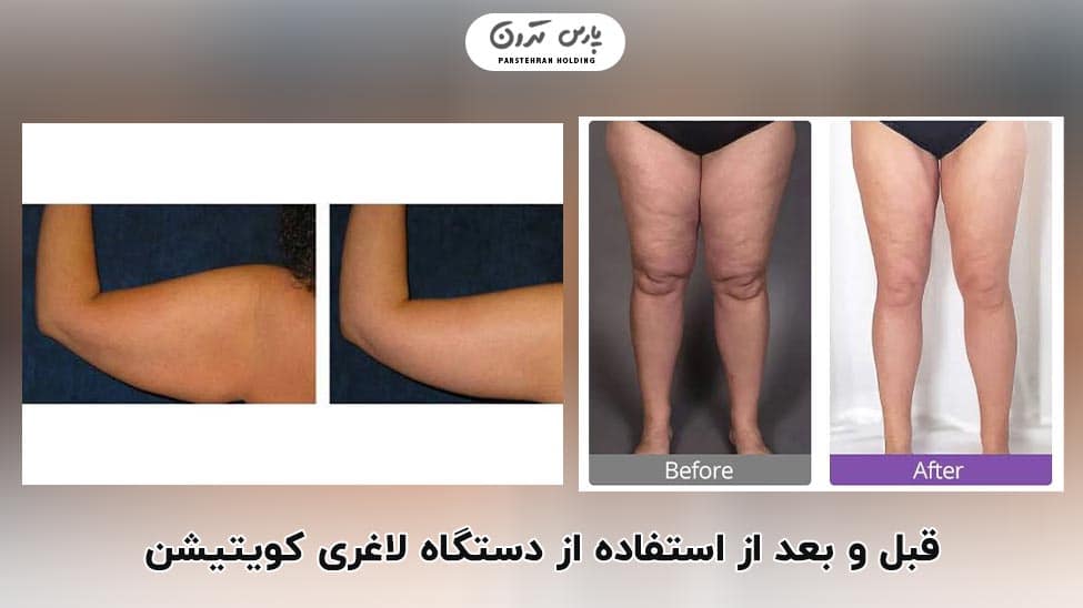 Before and after using the cavitation slimming machine قبل و بعد از استفاده از دستگاه لاغری کویتیشن