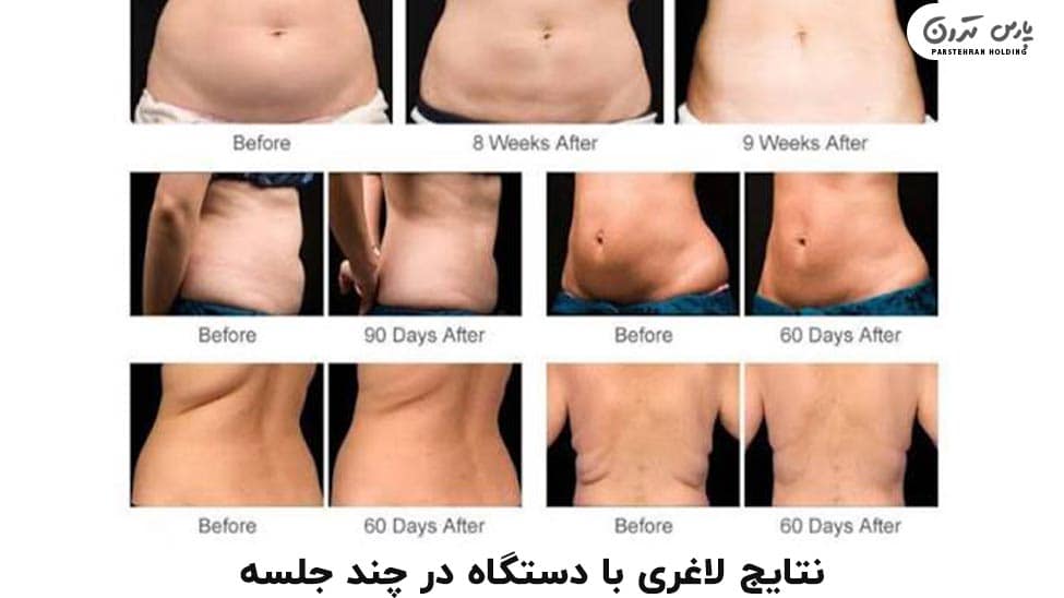 Weight loss results with the device نتایج لاغری با دستگاه