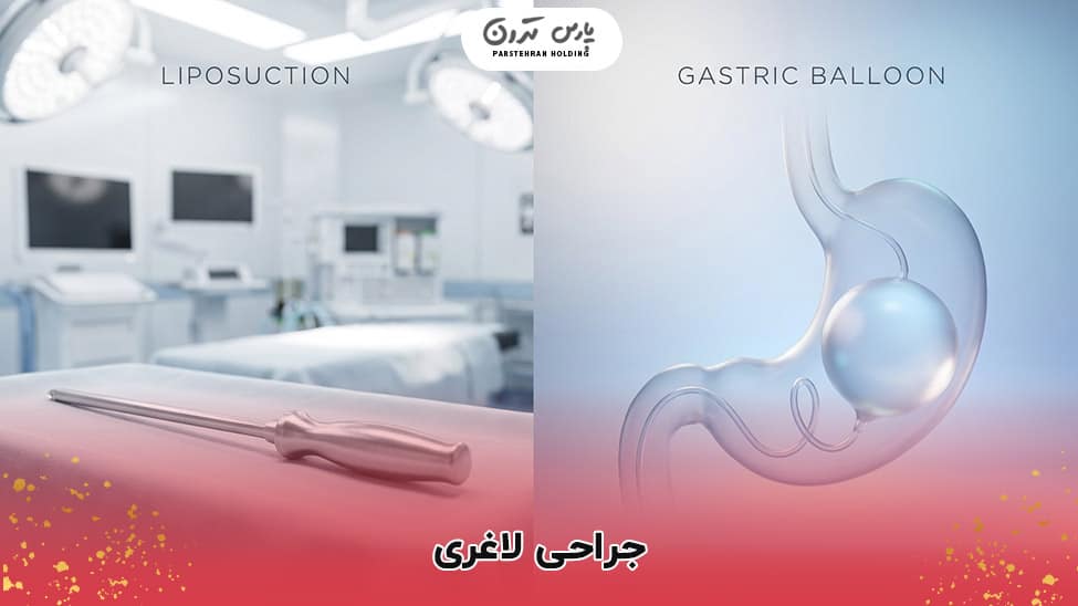 weight loss surgery جراحی برای لاغری و کاهش وزن