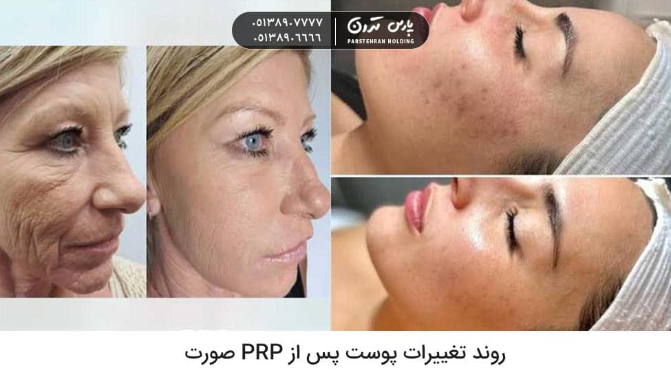 Skin changes after facial PRP روند تغییرات پوست پس از PRP صورت